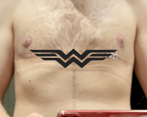 Foto-Montage des Narbenverlaufs nach Brust-Straffung mit Logo von Wonder Woman